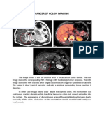 Cancer of Colon Imaging