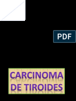 Carcinoma de Tiroides