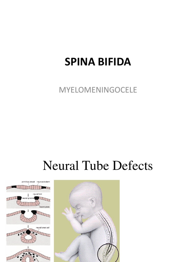 Myelomeningocele | PDF