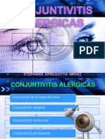 CONJUNTIVITIS ALERJICA