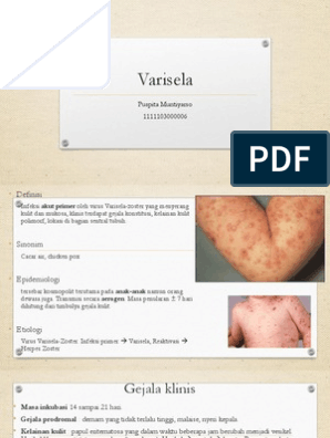 Varicele - Cauze, Simptome, Tratament | Ayurmed