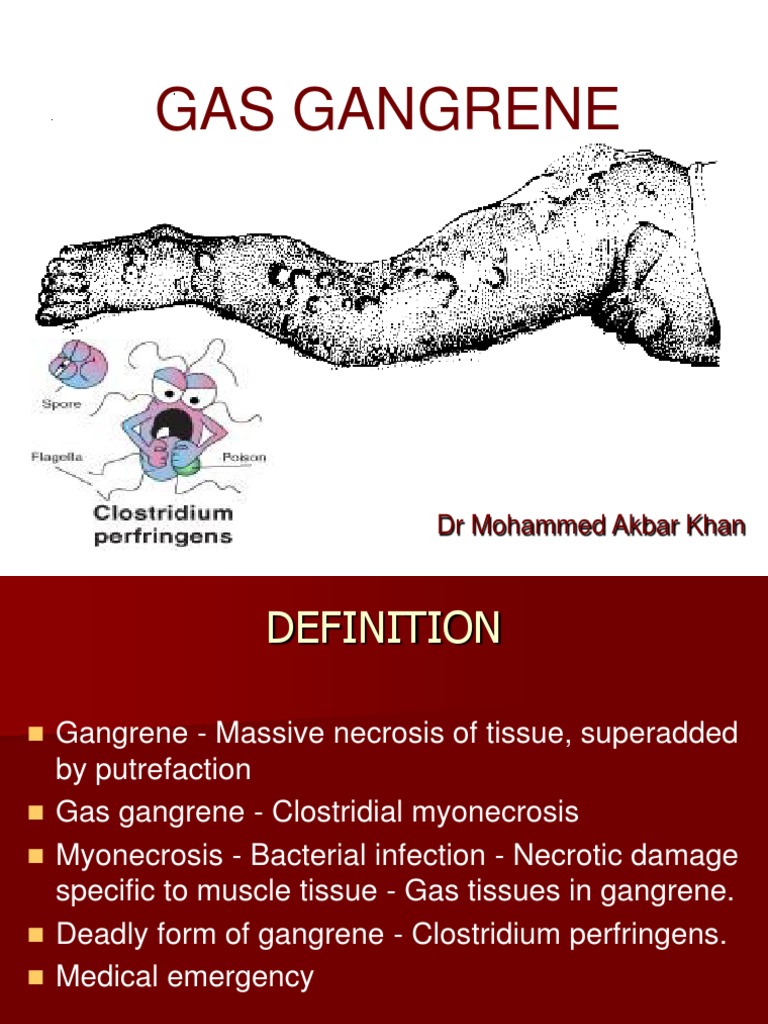 Gas Gangrene Dr Akbar Clinical Medicine Medicine