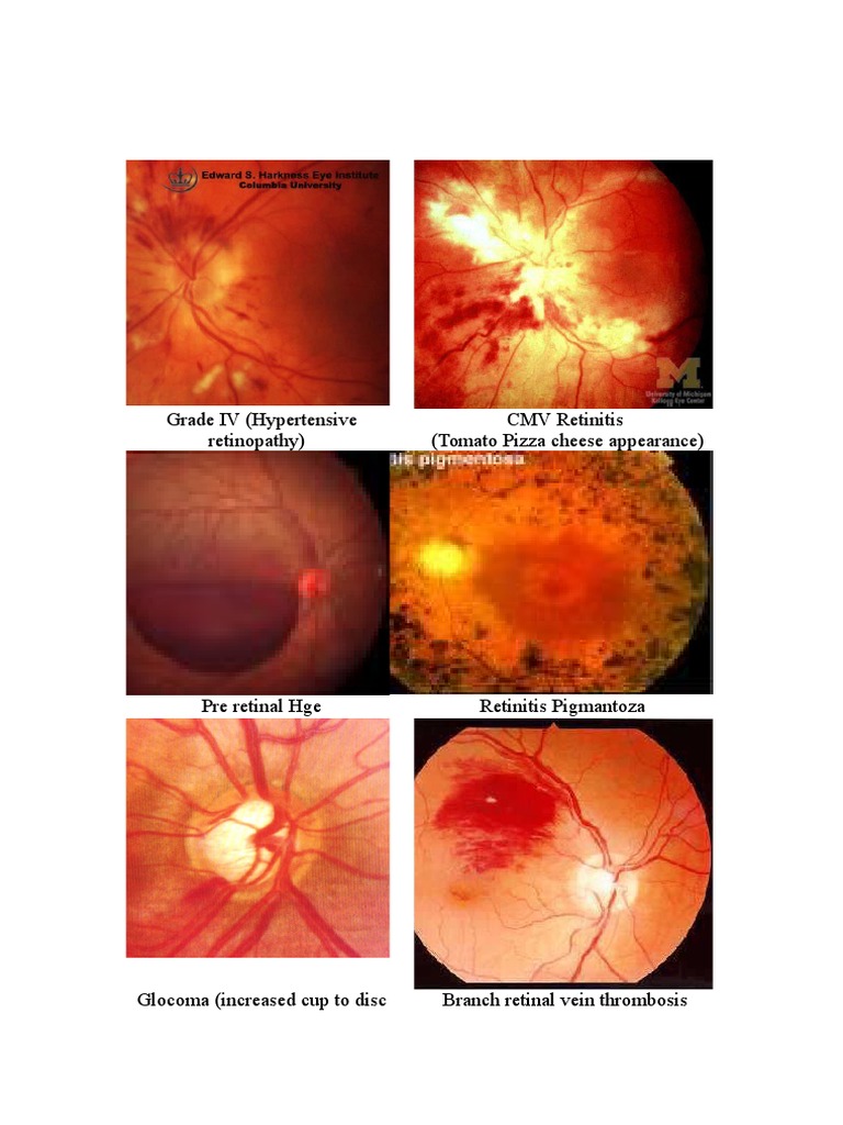 Labelled Fundus Pictures | PDF