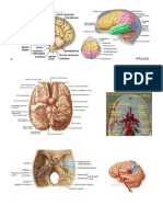 A CT Scan of The Head That Demonstrates A Left Occipital Arteriovenous Malformation