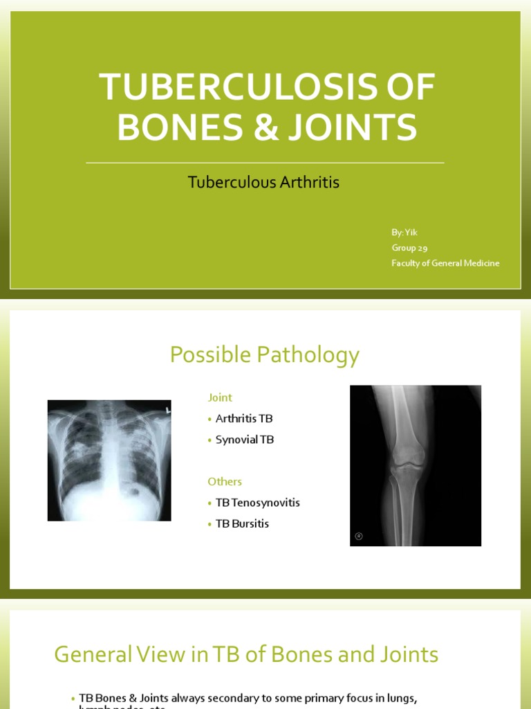 Bones and Joints TB PDF Tuberculosis Joint