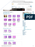 Transitional Cell Tumors: Benign Brenner Tumor