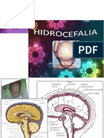 hidrocefalea