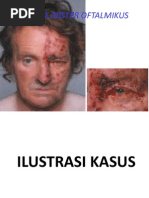 Herpes Zoster Oftalmikus