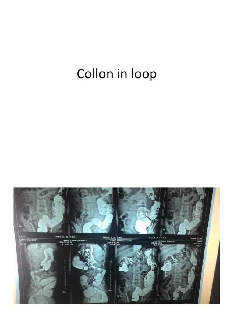 Collon in Loop | PDF