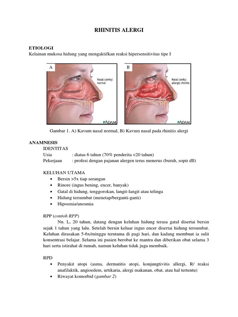 Rhinitis Alergi | PDF | Kesehatan Holistik