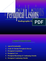 Periapical Lesions