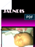 Jaundis