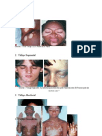 Gambar Vitiligo
