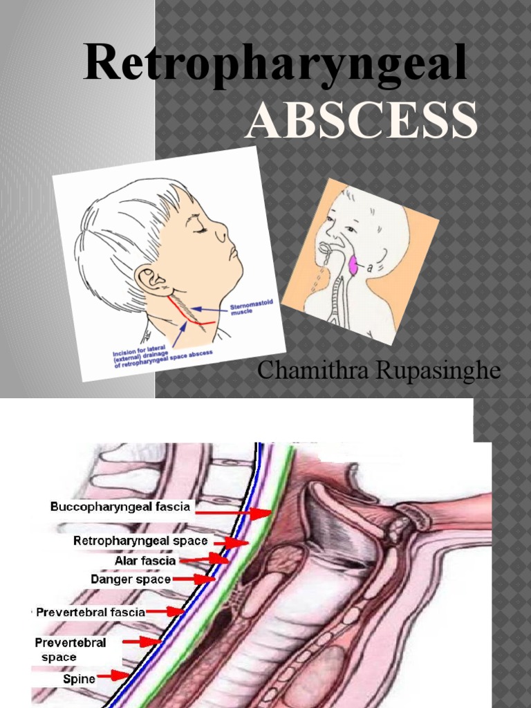 retropharyngeal-abscess-diagram
