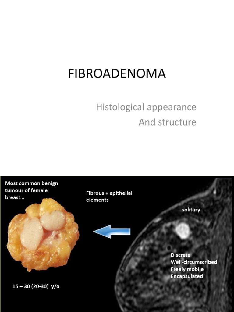 Fibroadenoma | PDF | Neoplasms | Biology
