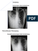 Pneumothorax