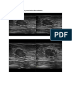 Well Defined Oval Mass That Proved To Be A Fibroadenoma