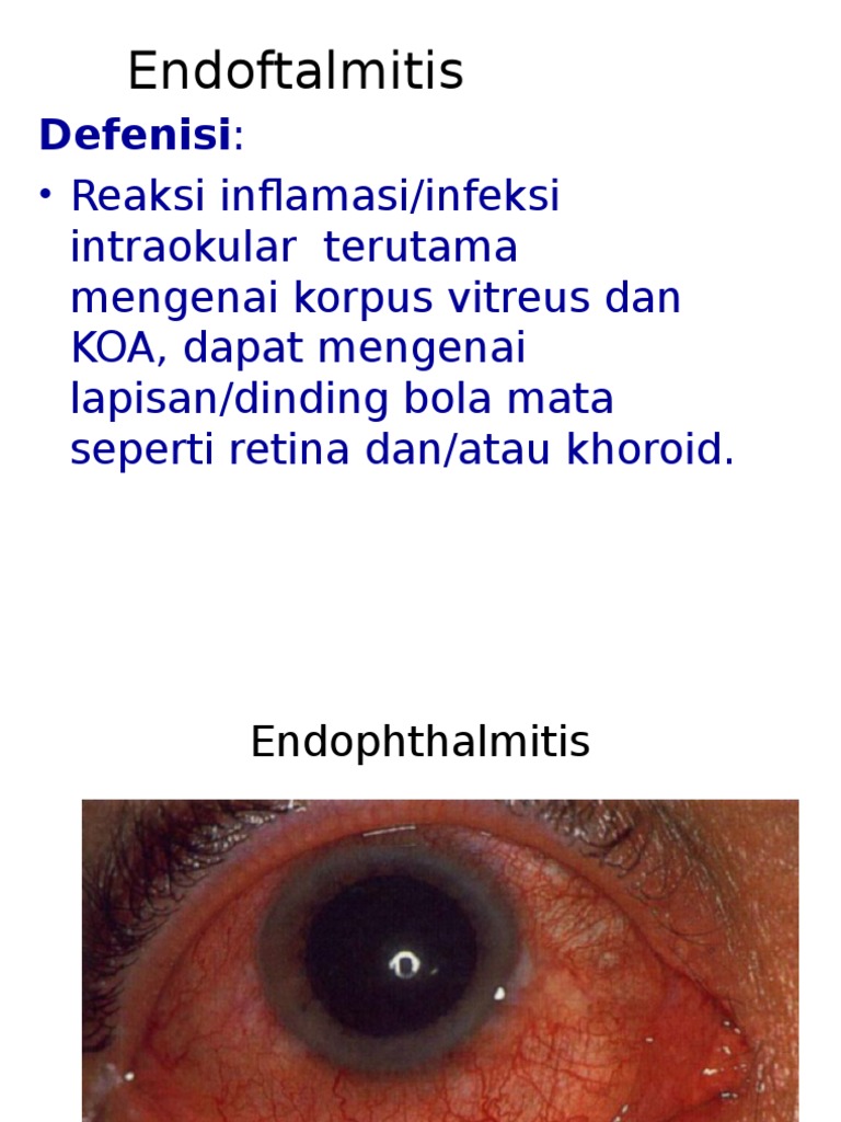 Understanding Endophthalmitis Types | PDF
