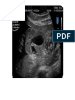 Atresia duodenal embriología