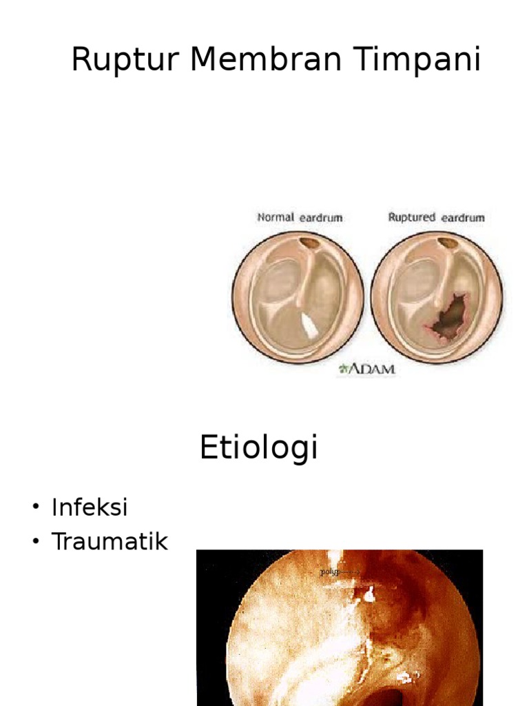 Ruptur Membran Timpani