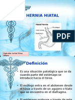 Hernia Hiatal