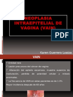 Neoplasia Intraepitelial de Vagina (Vain)