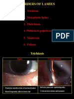 Disorders of Lashes: 1. Trichiasis 2. Metaplastic Lashes 3. Distichiasis 4. Phthiriasis Palpebrarum 5. Madarosis