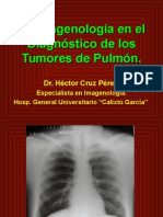 Radiología Básica Neoplasis Púlmón