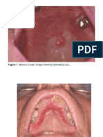 Denture Stomatitis