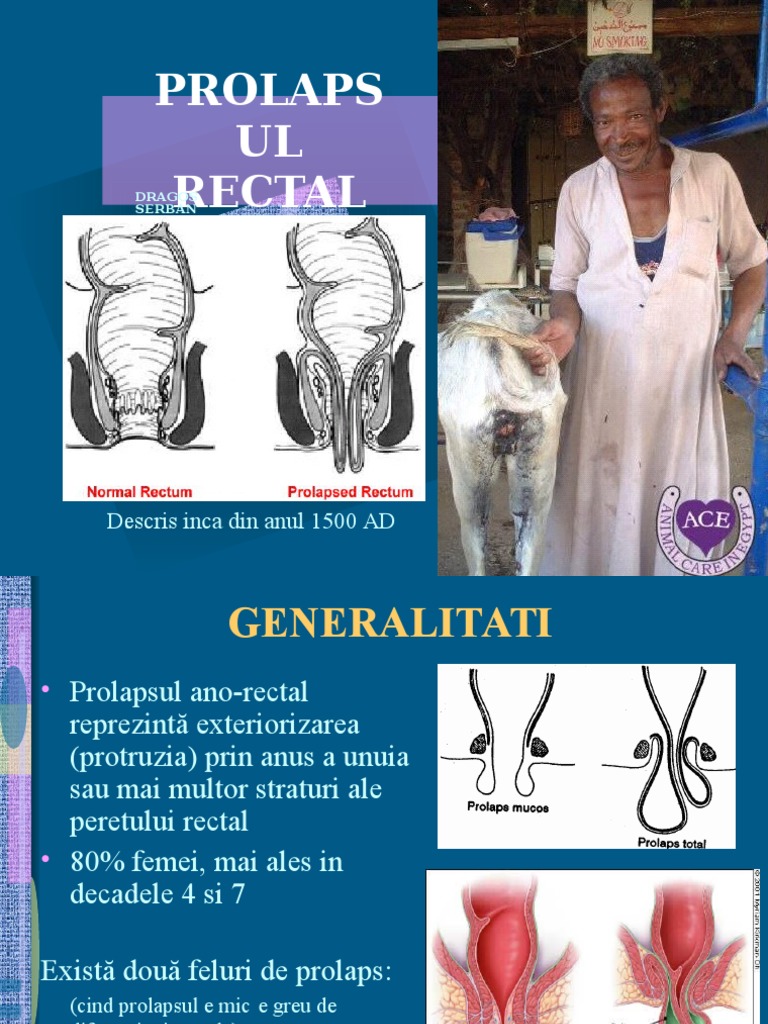 5.prolapsul Rectal | PDF