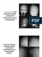 FRACTURi CRANIANE