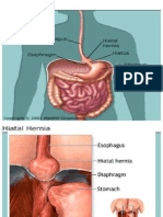 Hernia Hiatus