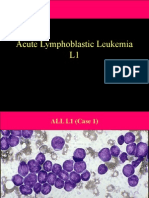 Acute Lymphoblastic Leukemia L1