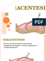 Paracentesis