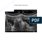 Multiple Gallstone Ultrasound