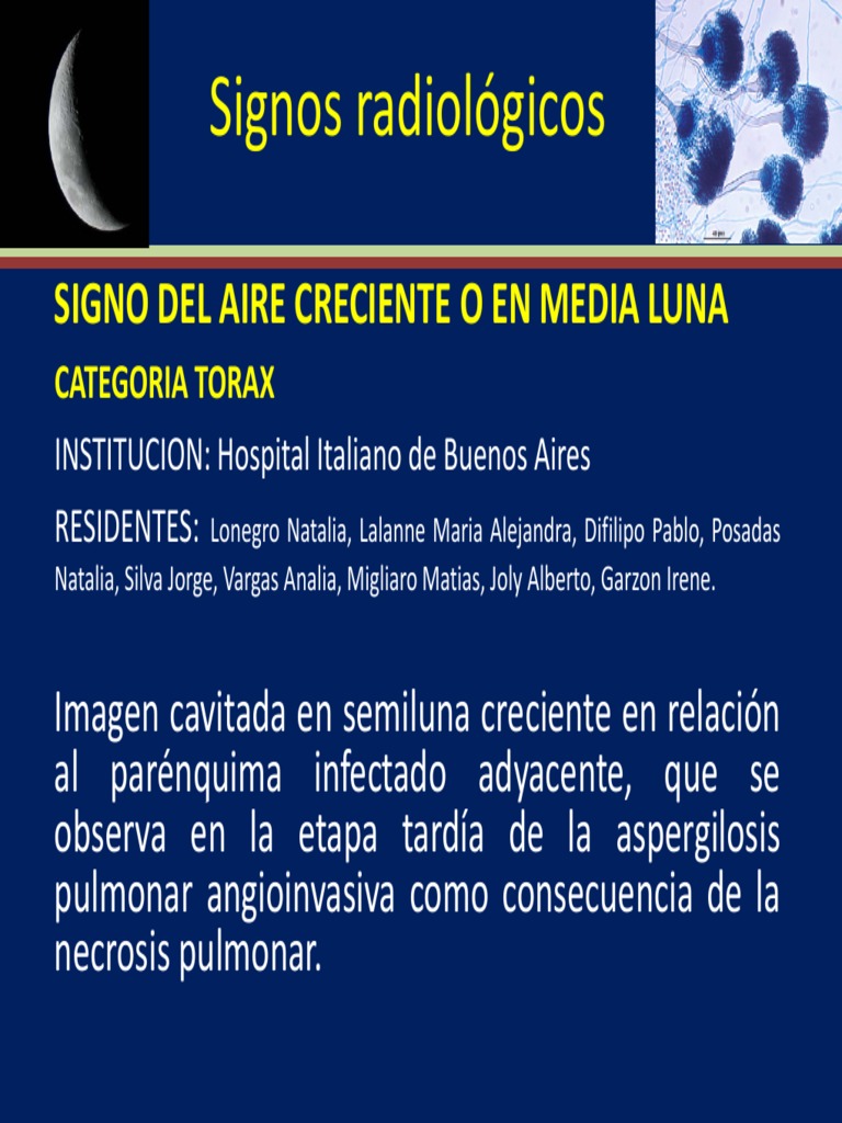 2012 - 87 - Torax Signo Radiológico de "MEDIA LUNA" | PDF