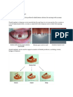 Dental Implants What Is Dental Implant?