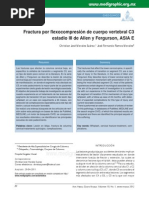 fractura por flexocompresion cervicales.pdf