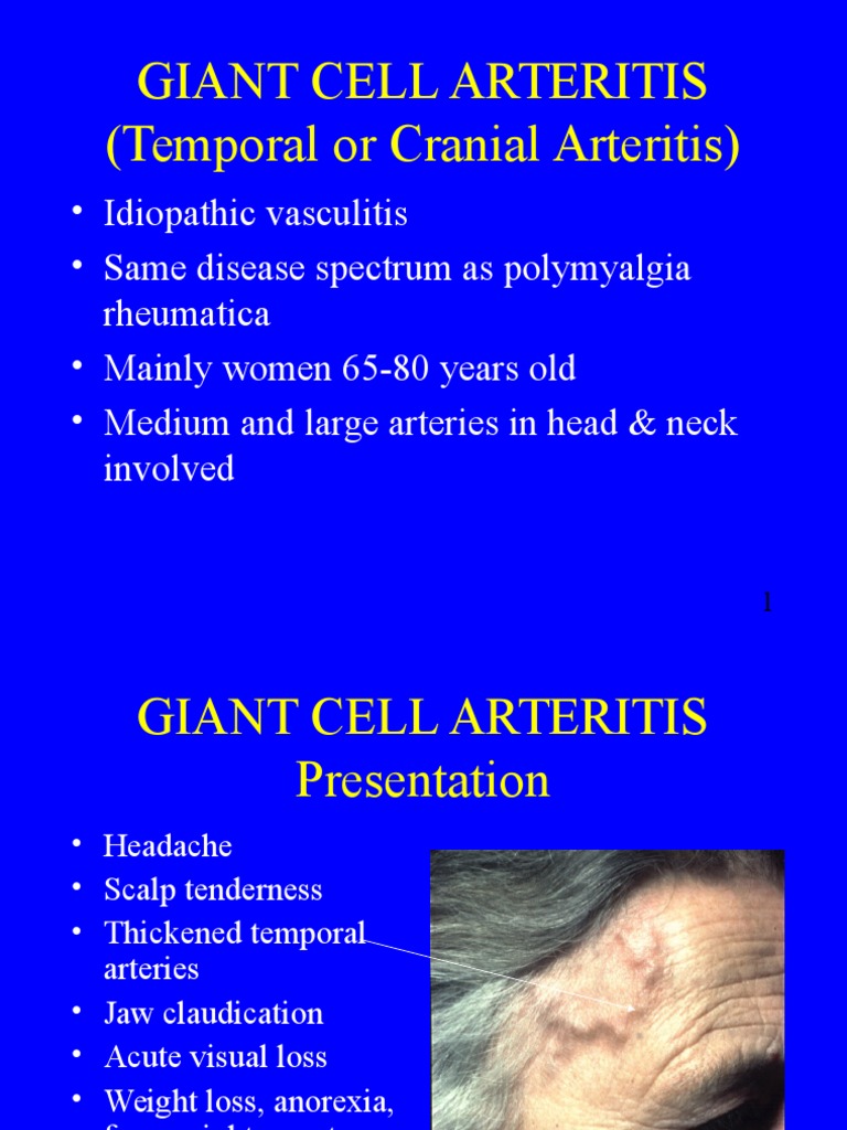 Giant Cell Arteritis Overview | PDF