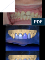 Veneer Student