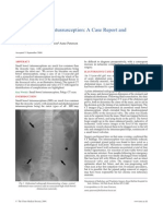 Intussusception