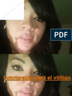 Fototerapia y Vitiligo