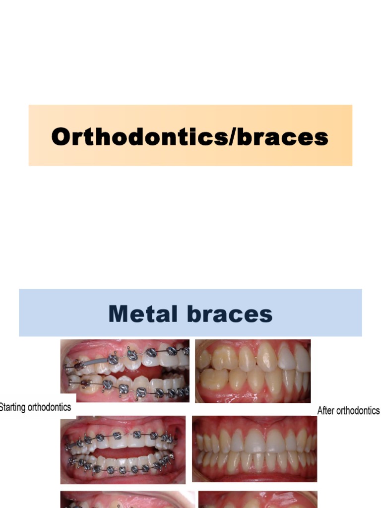 Orthodontics PPt Orthodontics Dentistry Branches