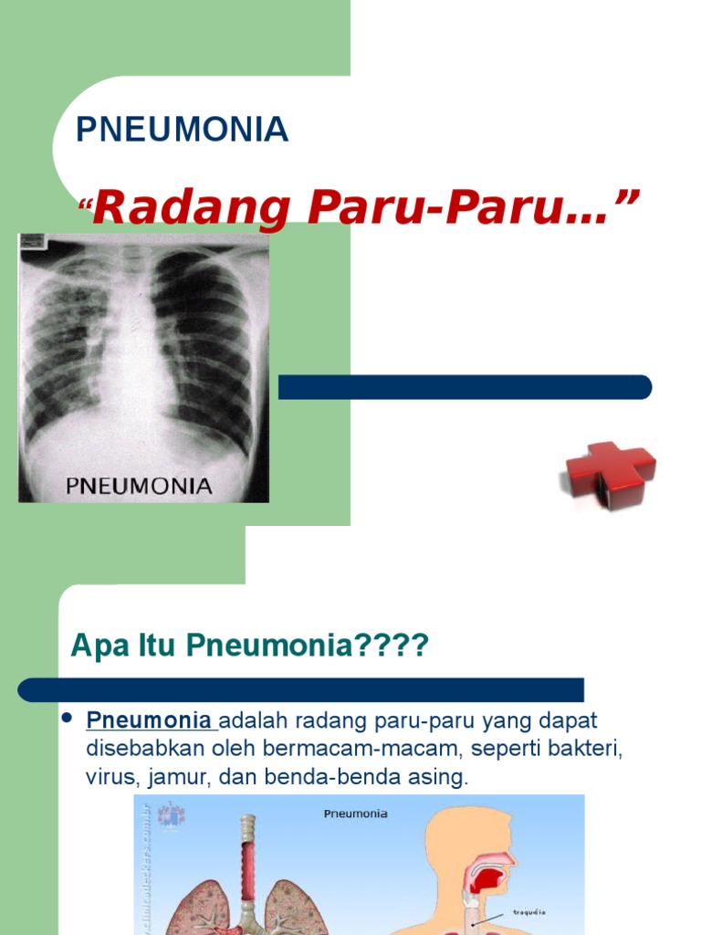 Left Lower Lobe Pneumonia Retrocardiac Consolidation Radiology Case Radiopaedia Org