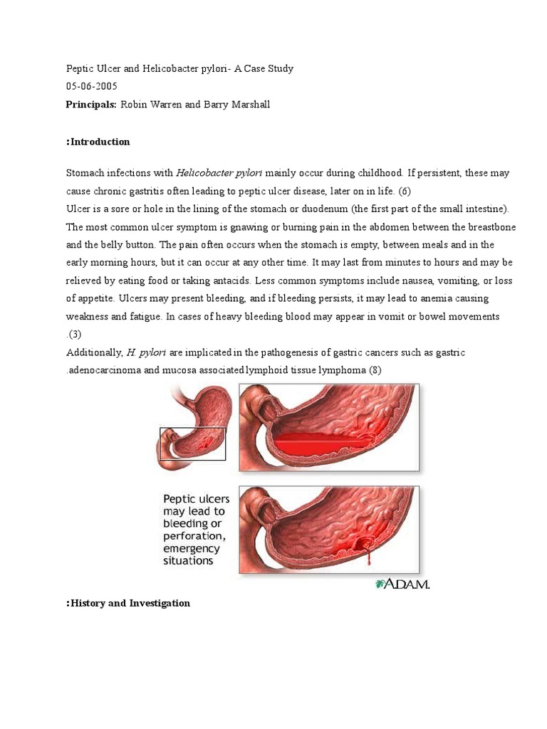 case study for peptic ulcer