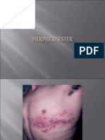 Herpes Zoester