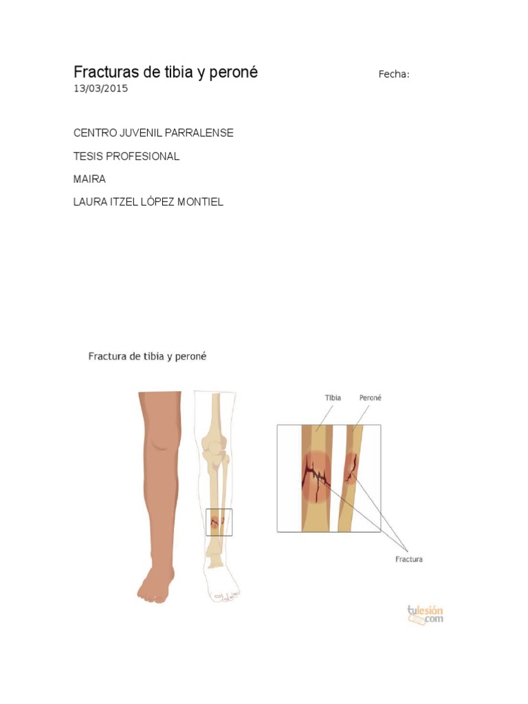 Fracturas de Tibia y Peroné | PDF