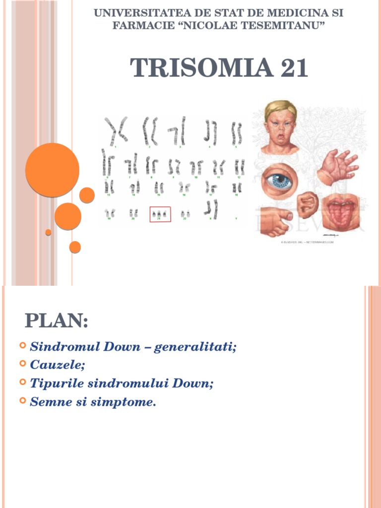 Trisomia 21