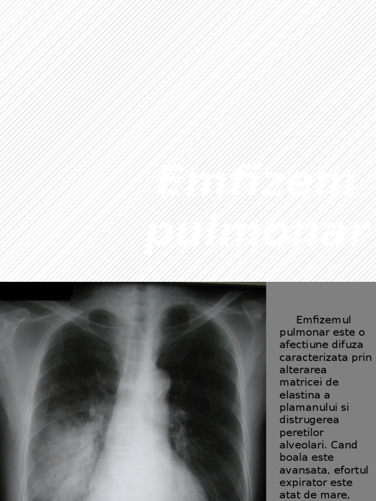 Emfizem Pulmonar | PDF