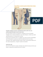 3 Asombrosos Remedios Caseros para Tratar Las Venas Varicosas Naturalmente